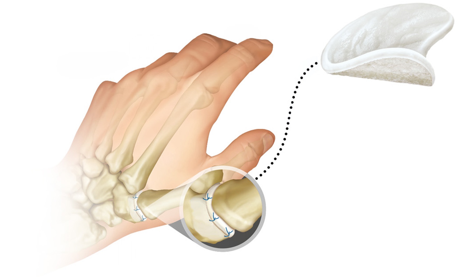 ALLIO device